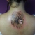 00104 ink4skin